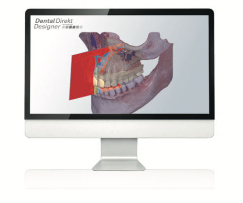 Exoplan by exocad® – für flexible Implantatplanung | 129375