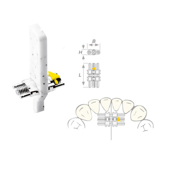 Dehnschraube Vector 050 micro 10St | 304405