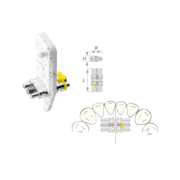 Dehnschraube Vector 100 mini 50St | 298566